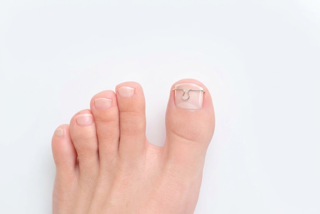 Nagelbeugel op een grote teen