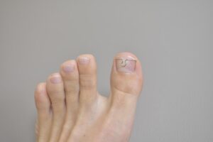 Nagelbeugel tegen ingegroeide nagel