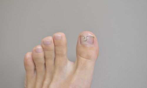 Nagelbeugel tegen ingegroeide nagel